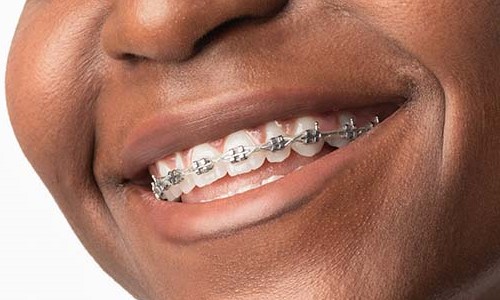 Healthy Smiles With Dental Braces