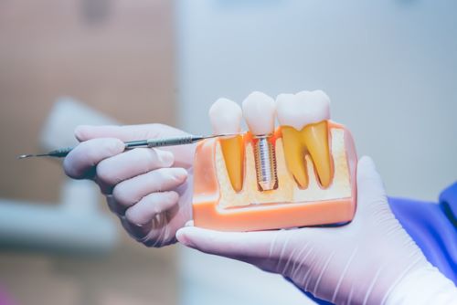 Care Of Dental Implants