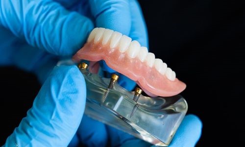 10 Reasons to Choose Implant-Supported Dentures