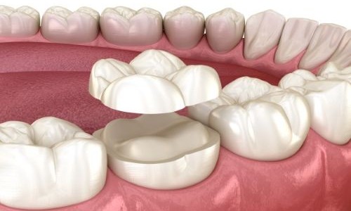 Bondable Crowns: The Future of Smile Restoration