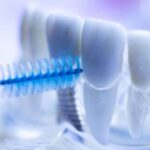dental implant cleaning