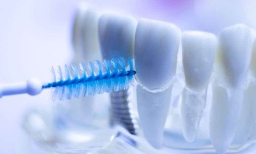 Dental Implant Aftercare: Secrets to Long-Term Success