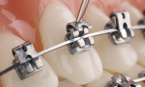 Modern Braces for Modern Smiles: Self-Ligating Technology